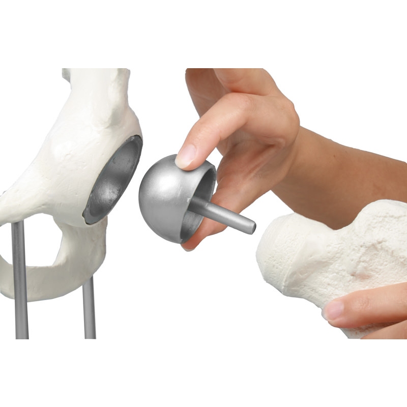 Kolčni sklep z vsadkom za obnavljanje