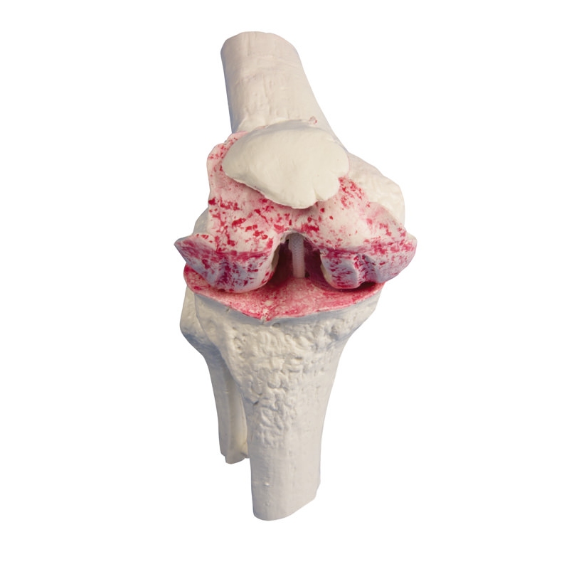 Kolenski model z implantantom