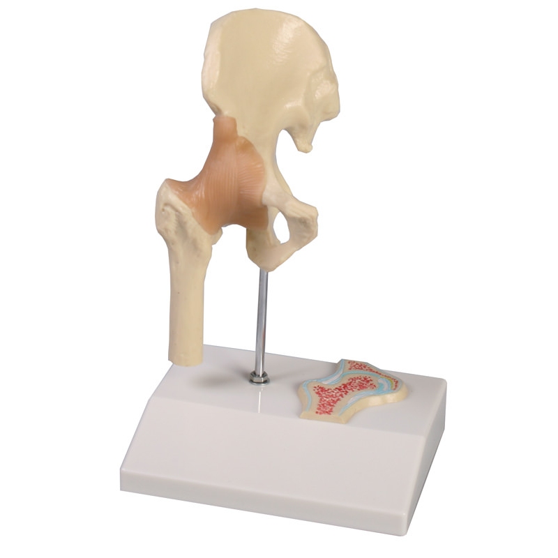 Miniaturni kolčni sklep s prečnim prerezom