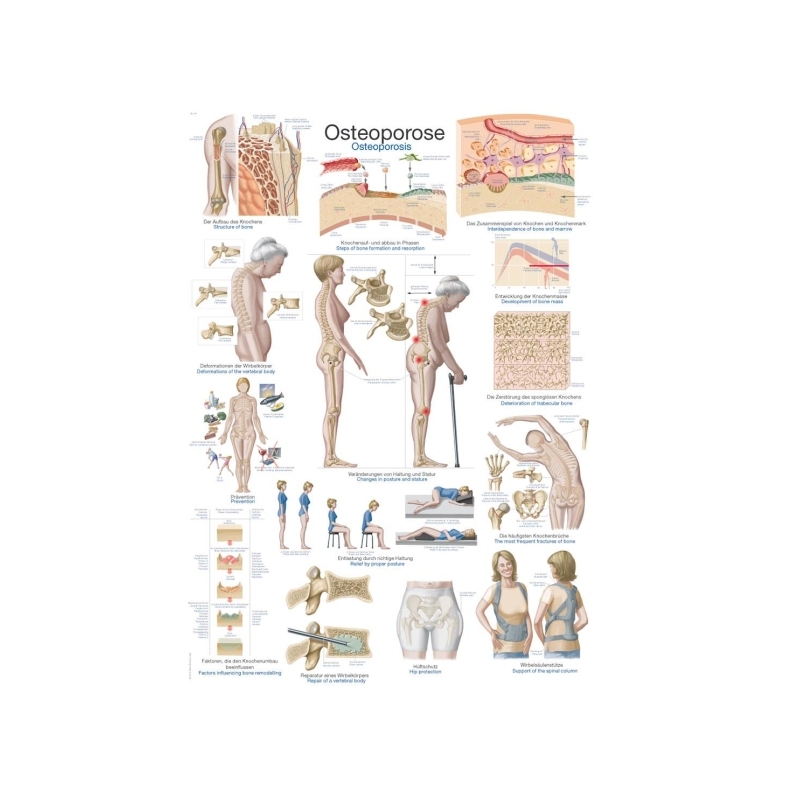 Graf Osteoporoza, 50x70cm (Angleško)