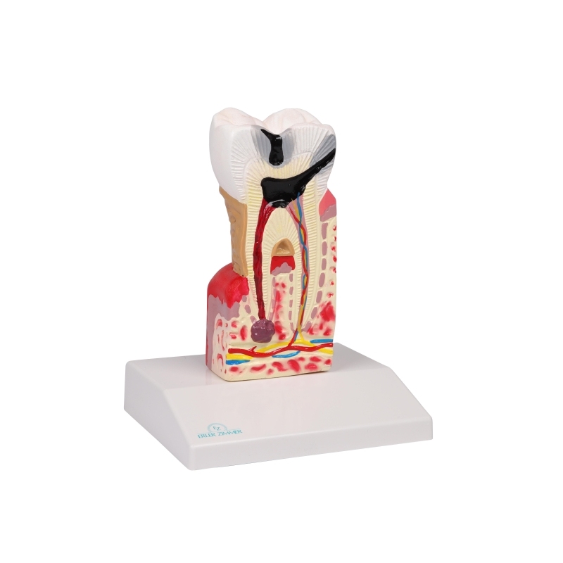Model zobnega kariesa v 10-kratni naravni velikosti