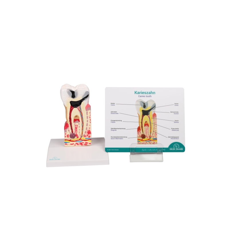 Model zobnega kariesa v 10-kratni naravni velikosti