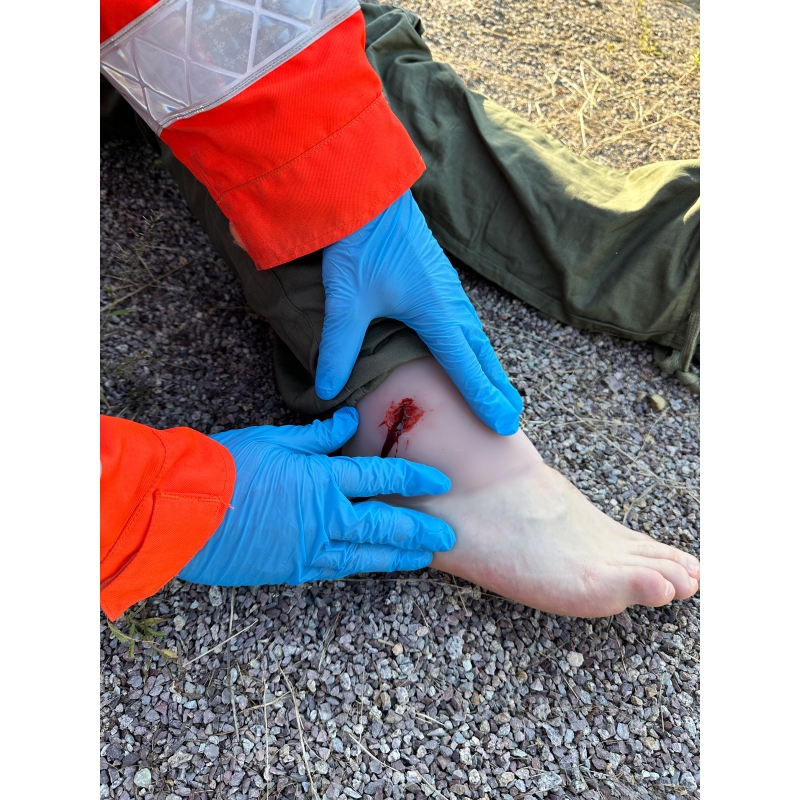 Mulaža rane, strel na gleženjski sklep