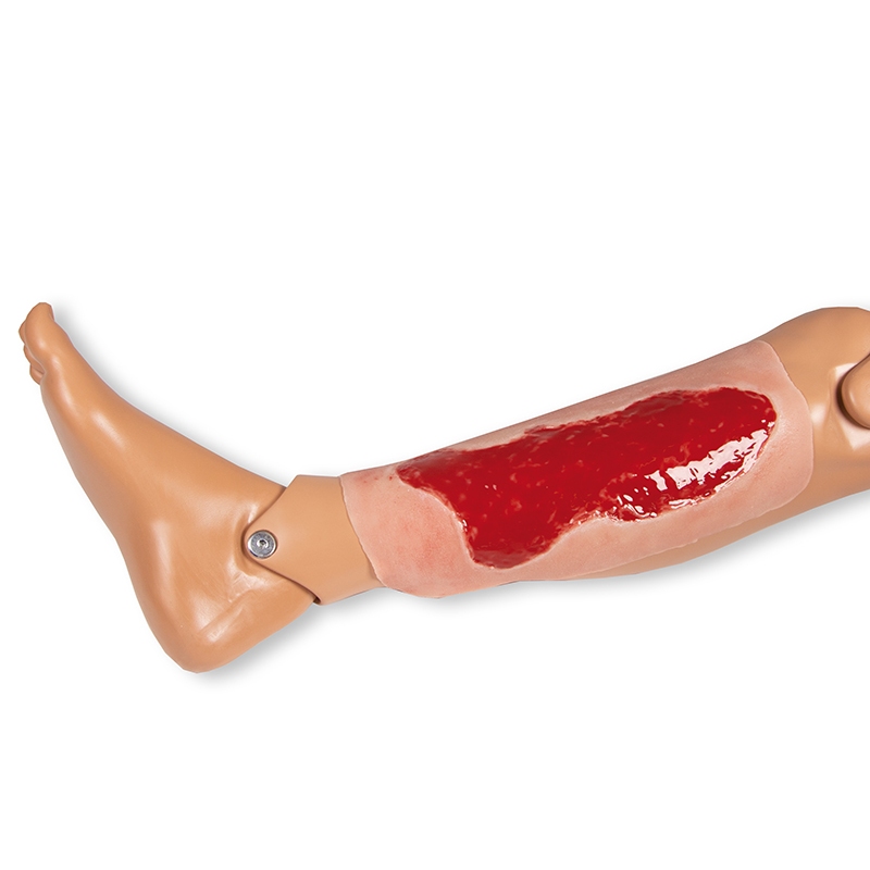 Mulaža rane venska razjeda na nogi, velika, faza granulacije