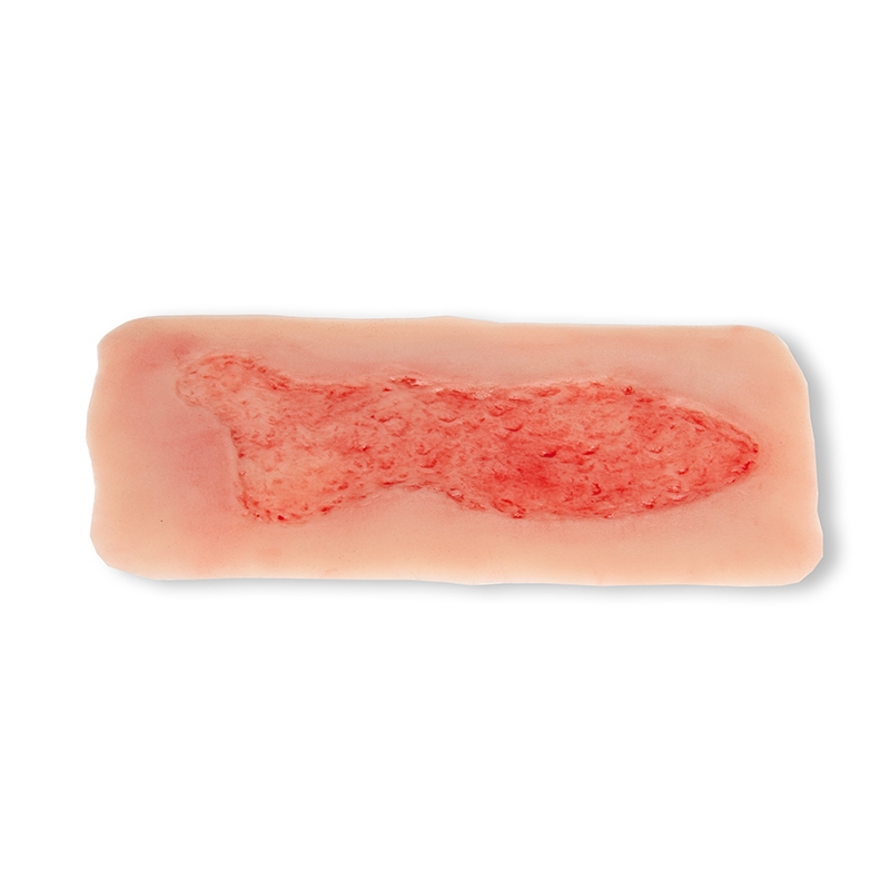 Mulaža rane venska razjeda na nogi, velika, faza epitelizacije