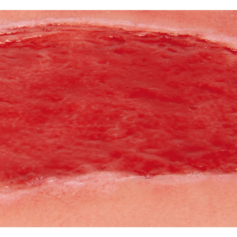 Mulaža rane arterijska razjeda na nogi, velika, faza granulacije