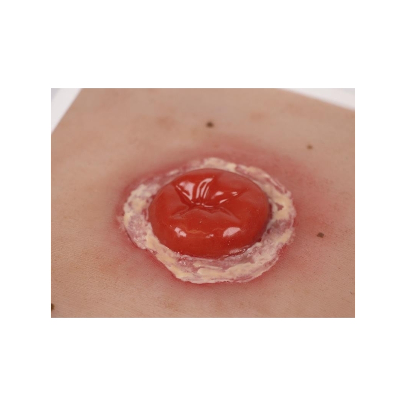 Mulaža rane Kolostoma z vnetjem, vključno s stojalom