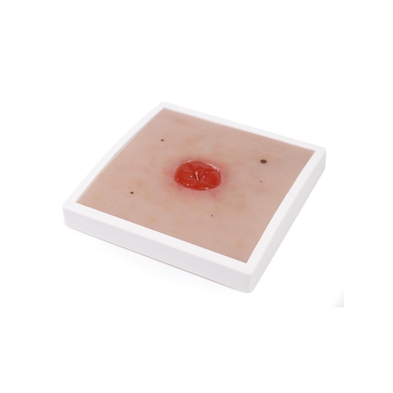 Moulage za rane Colostoma pod nivojem kože, vključno s stojalom