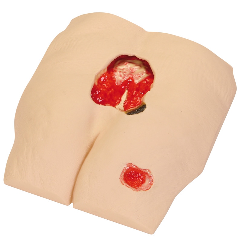  Model poškodb zaradi pritiska v fazi 4