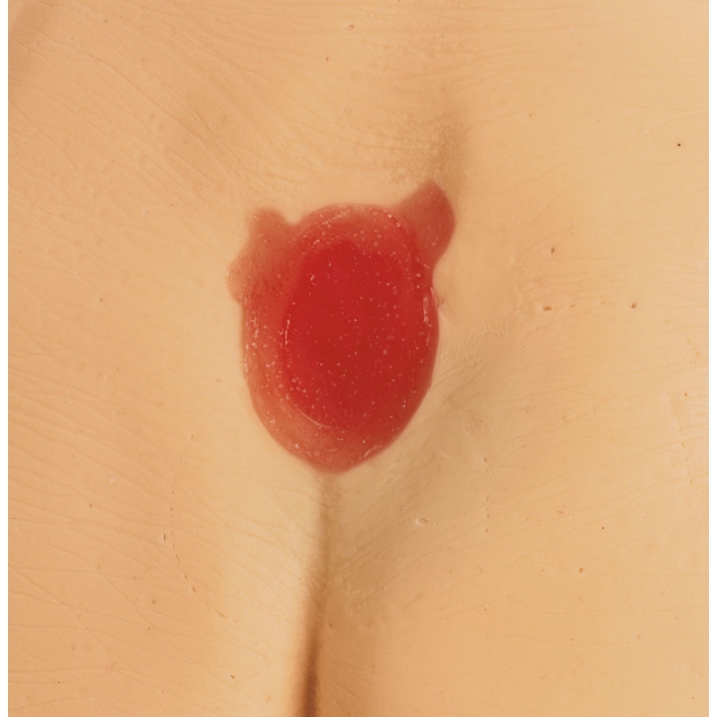 Modeli razjede zaradi pritiska / preležanin