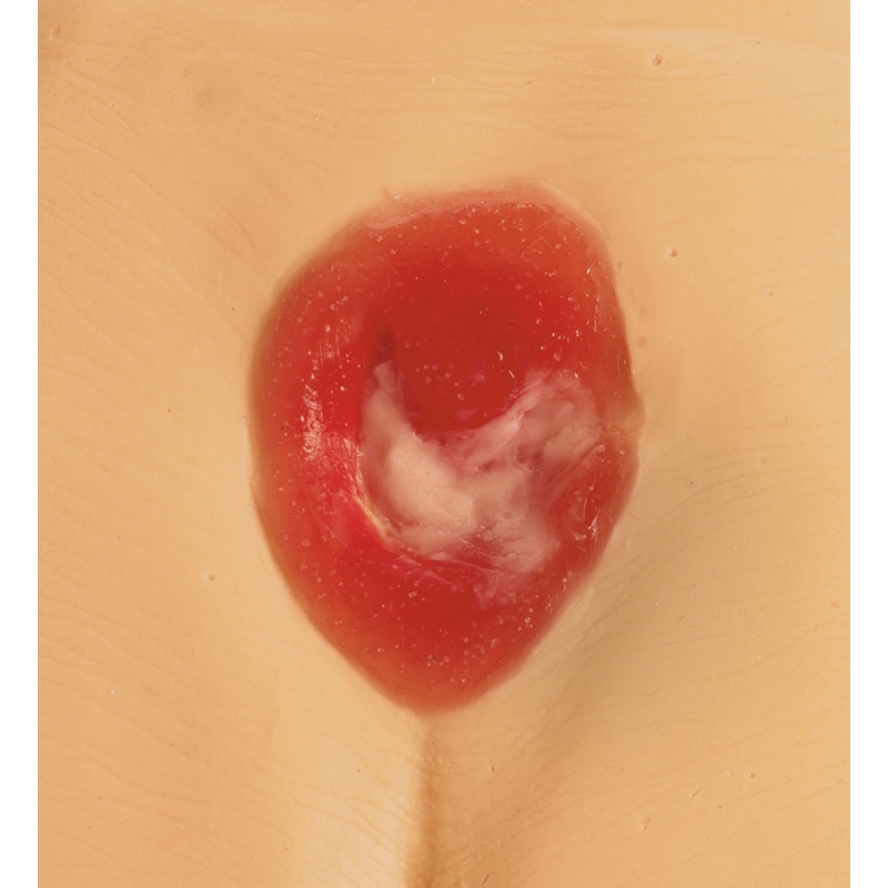 Modeli razjede zaradi pritiska / preležanin