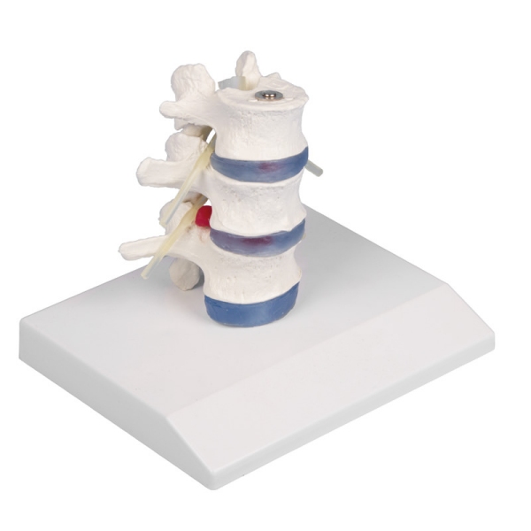 Ledvena vretenca s prolapsom medvretenčnih ploščic s stojiščem