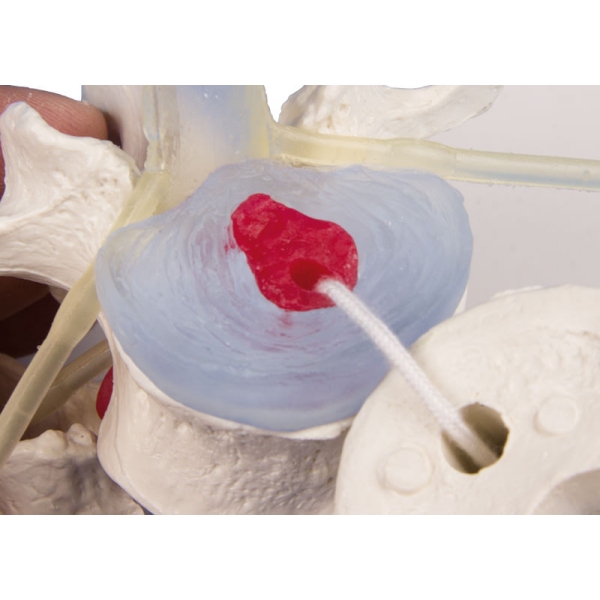 Ledvena vretenca s prolapsom medvretenčnih ploščic s stojiščem