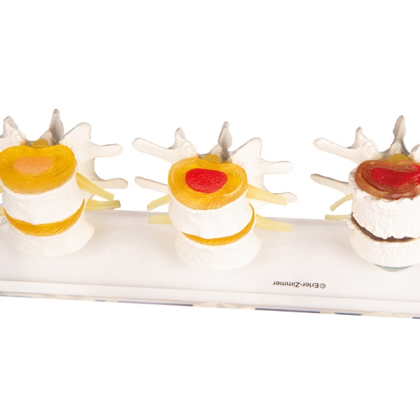 Stopnje degeneracije diska