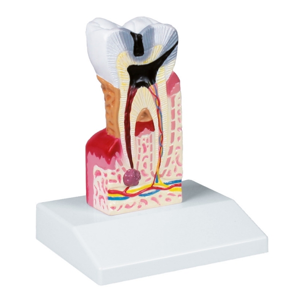 Model zobnega kariesa v 10-kratni naravni velikosti