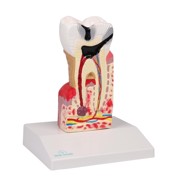 Model zobnega kariesa v 10-kratni naravni velikosti