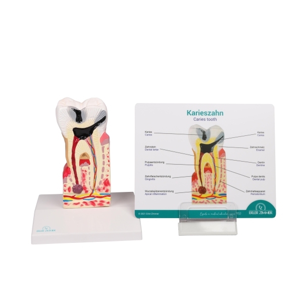 Model zobnega kariesa v 10-kratni naravni velikosti