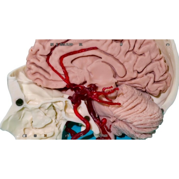 Arterije z anevrizmom