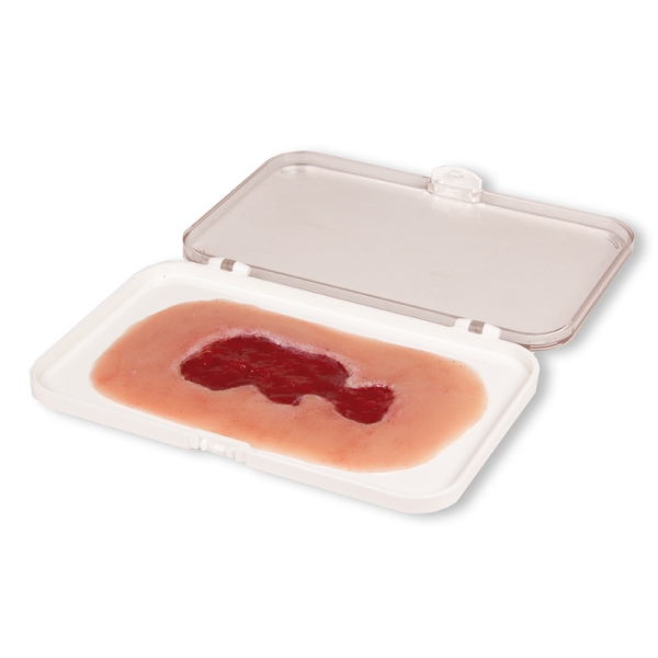 Mulaža rane venska razjeda na nogi, majhna, faza granulacije