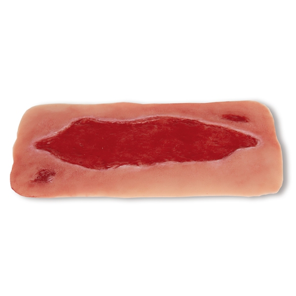 Mulaža rane arterijska razjeda na nogi, velika, faza granulacije