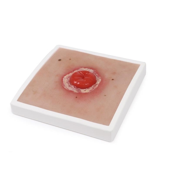 Mulaža rane Kolostoma z vnetjem, vključno s stojalom