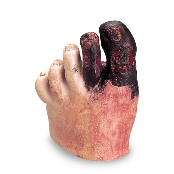 Model nezdravega stopala