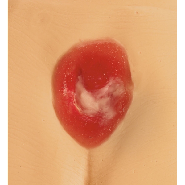 Modeli razjede zaradi pritiska / preležanin