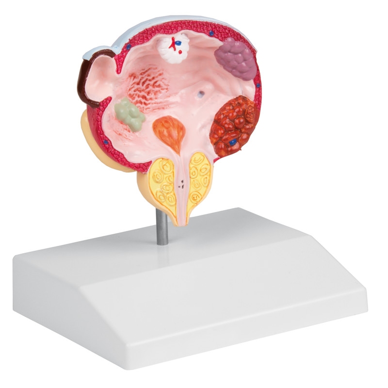 Bolezni mehurja in prostate