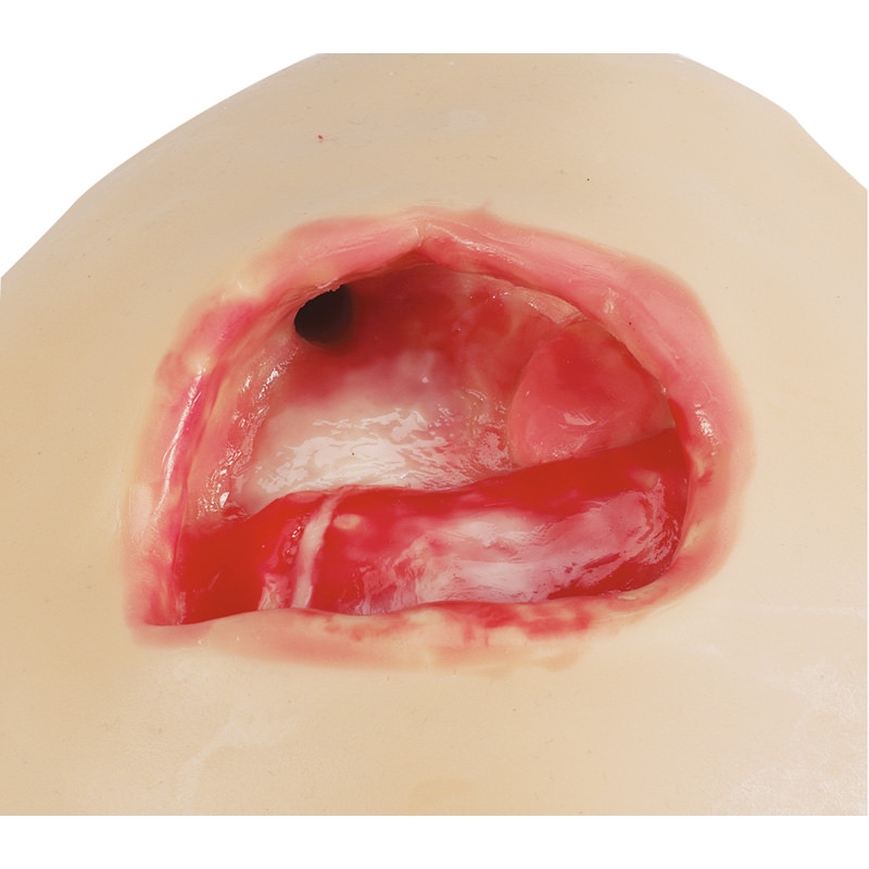 Trenerji za terapijo ran z negativnim tlakom (NPWT)