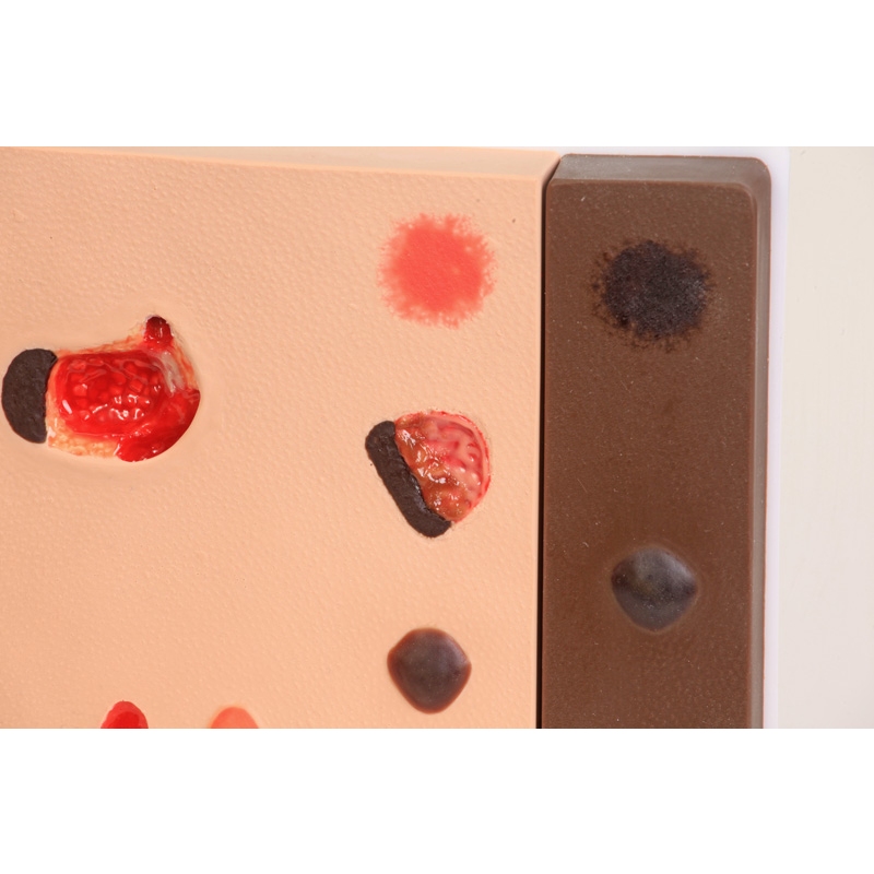 Model poškodbe zaradi pritiska