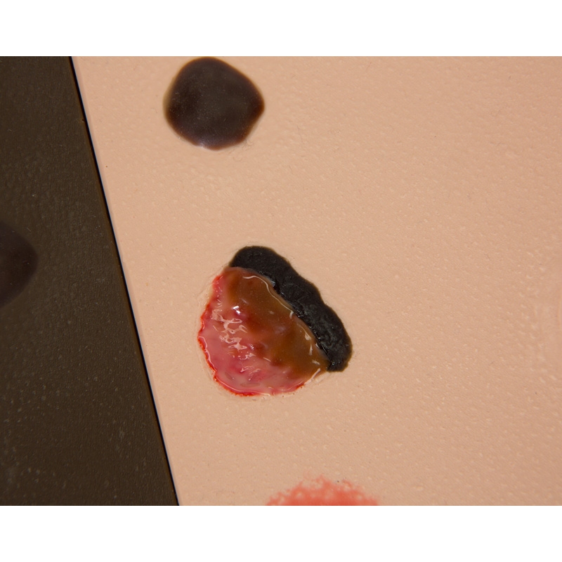 Model poškodbe zaradi pritiska