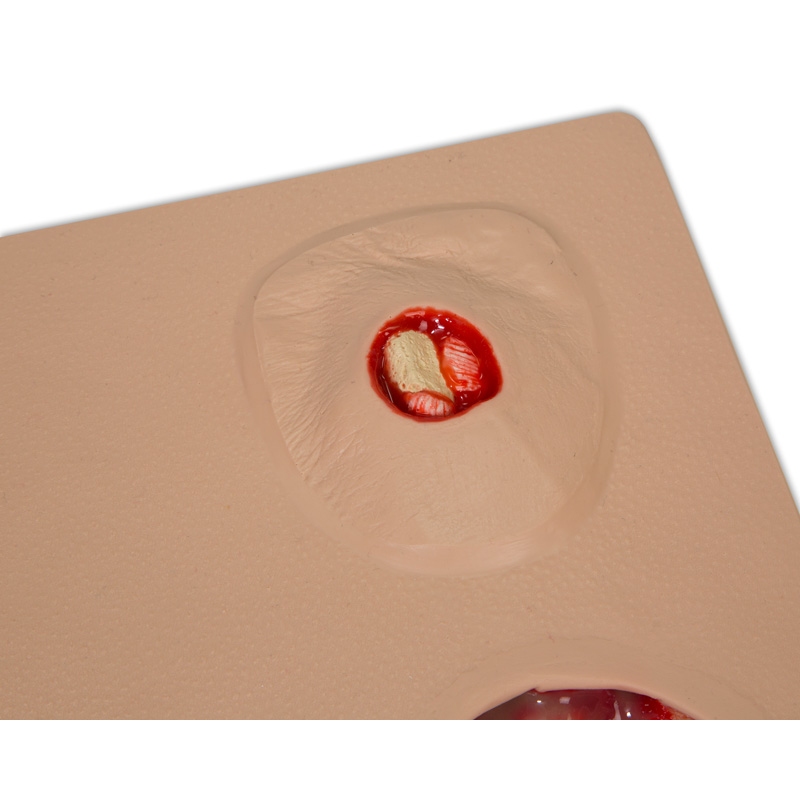 Model poškodbe zaradi pritiska