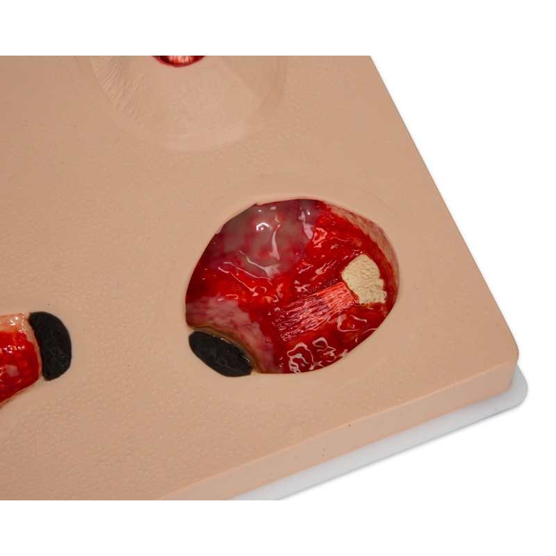 Model poškodbe zaradi pritiska