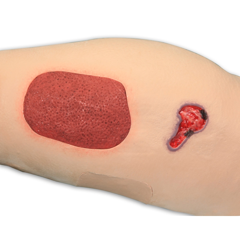 Vinnie venska nezadostnost noge