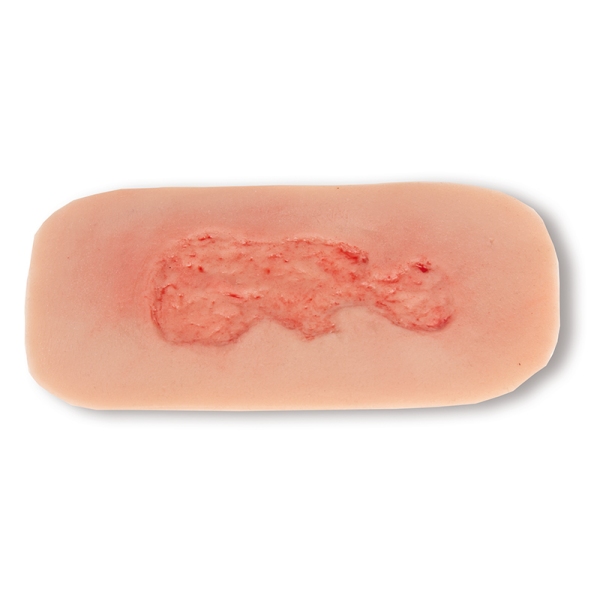 Mulaža rane venska razjeda na nogi, majhna, faza epitelizacije