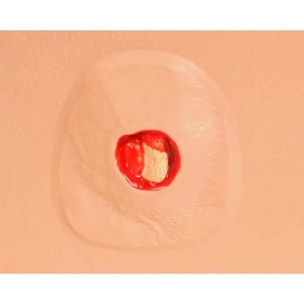 Model poškodbe zaradi pritiska