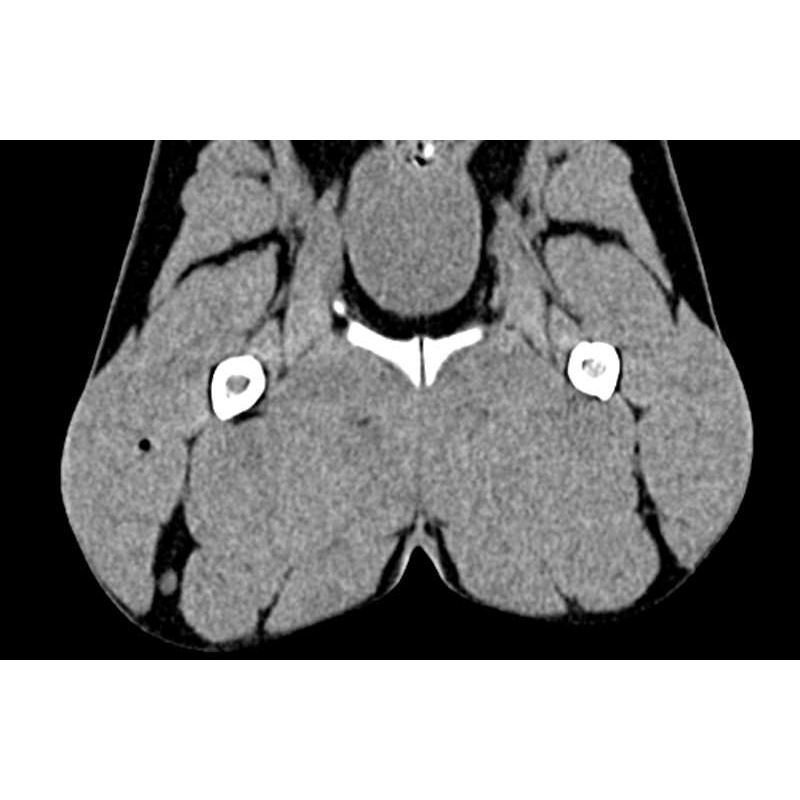 Fantom pasje medenice za CT in rentgensko slikanje