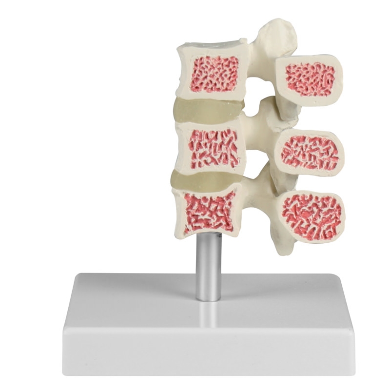Model vretenc za osteoporozo, 3 vretenca