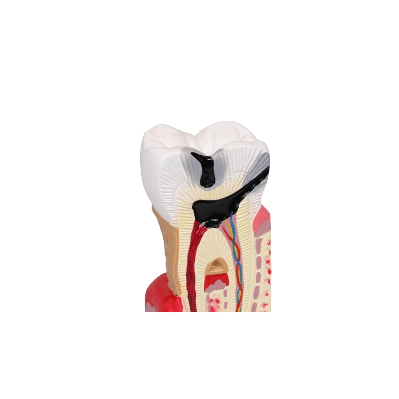 Model zobnega kariesa v 10-kratni naravni velikosti