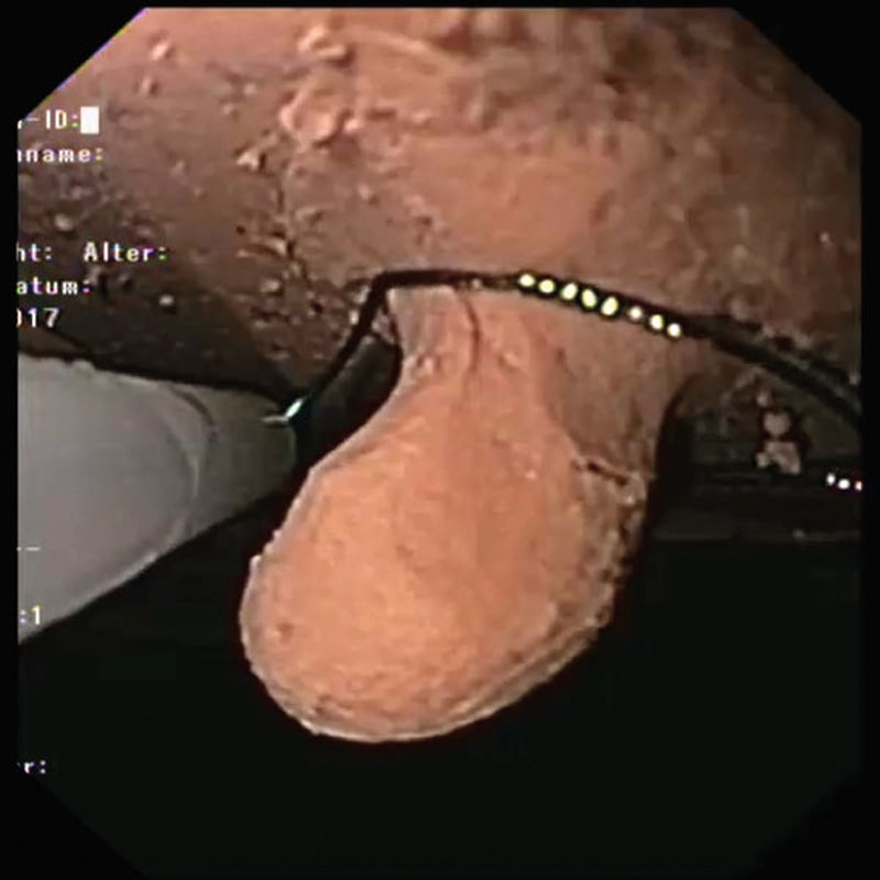 Gastroskopija-Simulator Gastro (EGD)