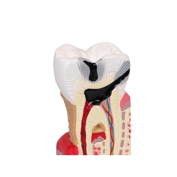 Model zobnega kariesa v 10-kratni naravni velikosti