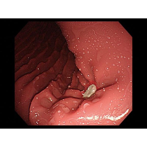 Simulator EGD (ezofagoGastroDuodenoskopija)