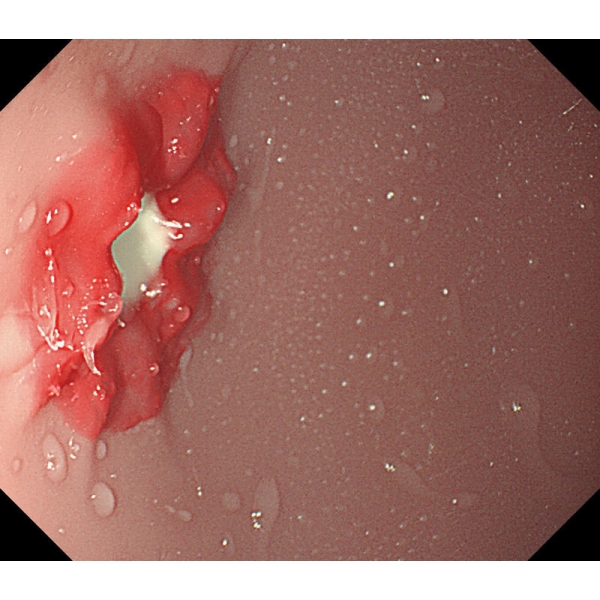 Simulator EGD (ezofagoGastroDuodenoskopija)
