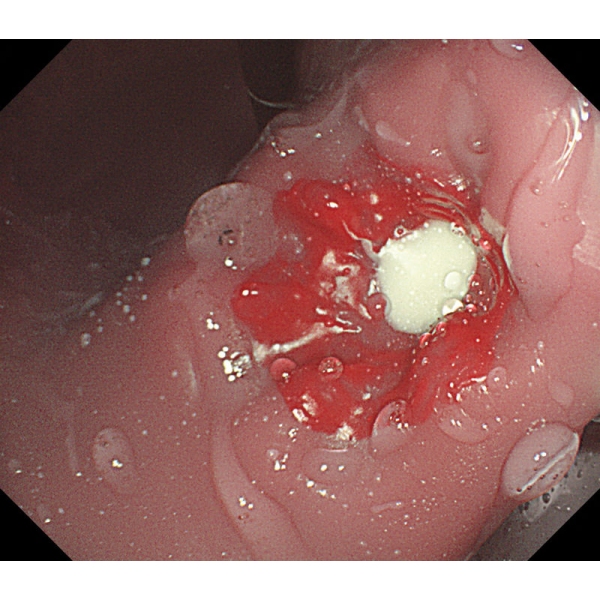 Simulator EGD (ezofagoGastroDuodenoskopija)