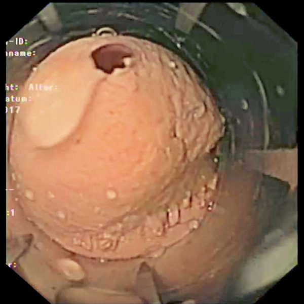 Gastroskopija-Simulator Gastro (EGD)