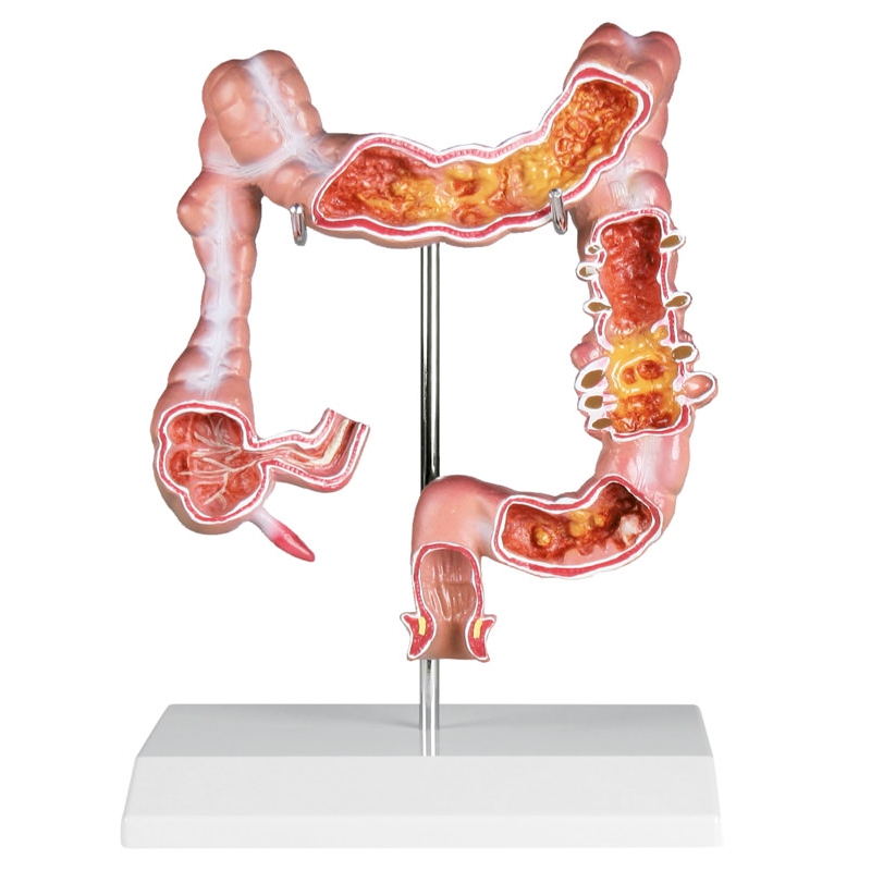  Model debelega črevesa z boleznimi